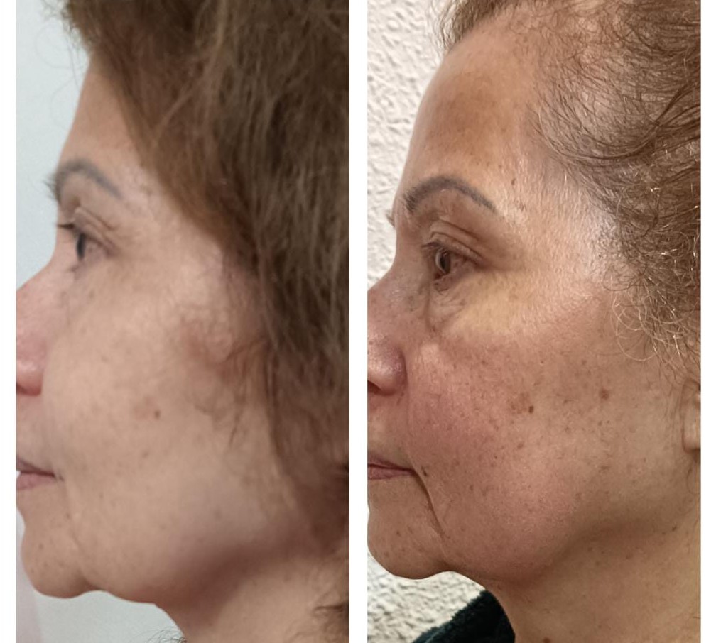 qué es el kinesiolifting facial